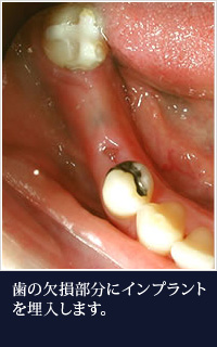 歯の欠損部分にインプラントを埋入します。